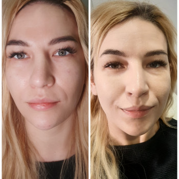 Збільшення скул