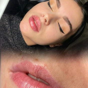 Контурна пластика губ