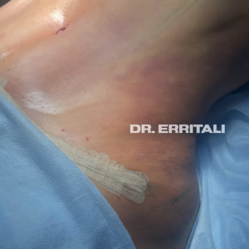 Абдоминопластика (пластика живота)
                    Пластический хирург Абдель Харьков