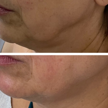 Фото из портфолио косметолога Зинаида Шуллер (Ужгород)