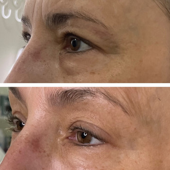 Фото из портфолио косметолога Зинаида Шуллер (Ужгород)