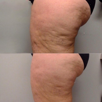 Ендосфера терапія позбавлення від целюліту