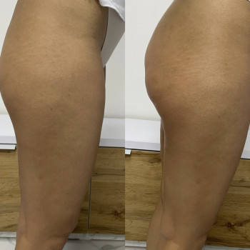 Підтяжка сідниць після процедури RF ліфтинг INDIBA