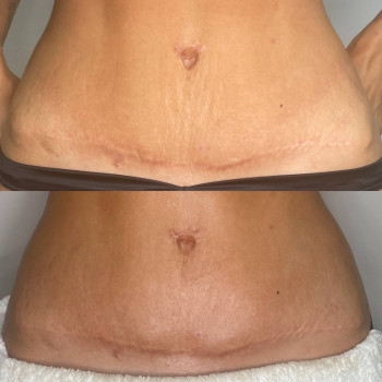 Розтяжки на животі одразу після процедури RF ліфтинг INDIBAj