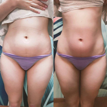 Розщеплення жиру на животі і боках після процедури RF ліфтин