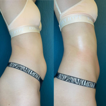 Розщеплення жиру на животі після процедури RF ліфтинг INDIBA