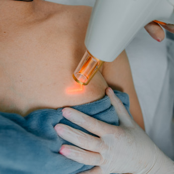 Видалення розтяжок (стрій) Lumenis M22 модуль ResurFX