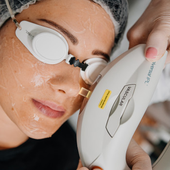 Видалення судин Lumenis M22 модуль IPL