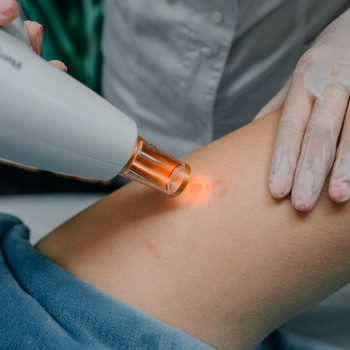 Видалення шрамів Lumenis M22 модуль ResurFX