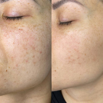 Фотоомолодження Lumenis M22