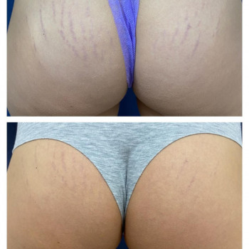 Lumenis M22 видалення розтяжок на сідницях