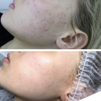 Результат лікування акне Lumenis M22 через місяць після проц