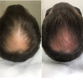 Lumenis M22 лікування облисіння