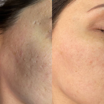 Лазерне шліфування Lumenis M22 модуль ResurFX