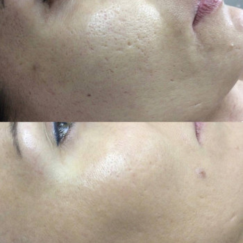 Lumenis M22 Фракційне омолодження