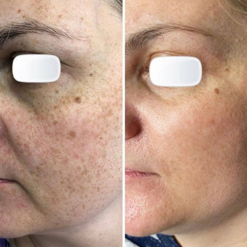 Видалення пігментації Lumenis M22