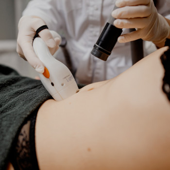 Лазерна епіляція живота