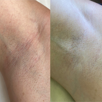 Результат після 3-х сеансів лазерної епіляції