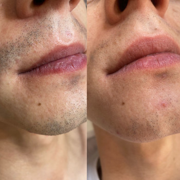 Lumenis Desire результат після першої процедури лазерної епі