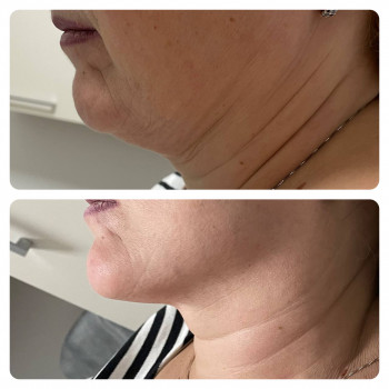 Зона підборіддя через 30 днів після кріоліполізу