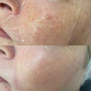 Лазерное лечение сосудистых сеточек
                    Косметологічний центр Celebriti Черкаси