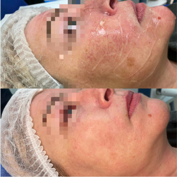 Фотоомоложение
                    Косметологічний центр Celebriti Черкаси