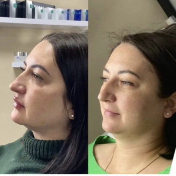 Контурная пластика
                    Косметологический центр Celebriti Черкассы