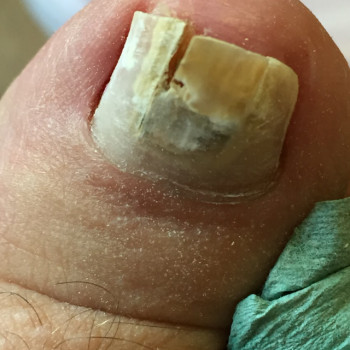 До лікування