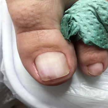 Після лікування