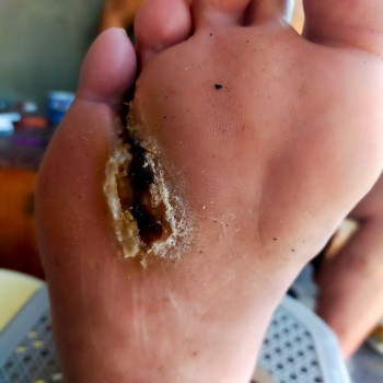 Діабет, до обробки