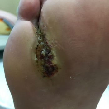 Діабет, після педикюру