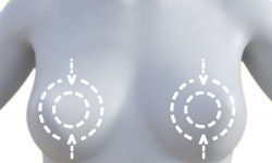 Вертикальна пластика молочних залоз Медицинский центр Alpha Cell Ровно