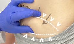 Мініабдомінопластика Медицинский центр Alpha Cell Ровно