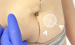 Лапароскопічна герніопластика Медичний центр Alpha Cell Рівне