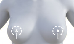 Вторинна мастопексія Медичний центр Alpha Cell Рівне