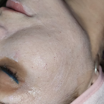 Чистка обличчя, пілінг
                    Лікар-косметолог Наталія Чернівці