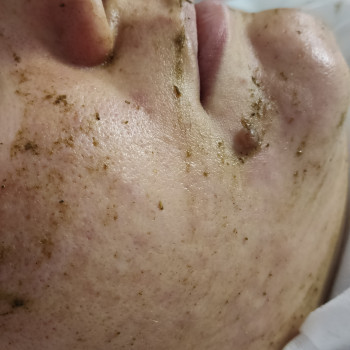 Чистка обличчя, пілінг
                    Лікар-косметолог Наталія Чернівці