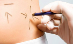 Ліпосакція Медицинский центр Alpha Cell Ровно