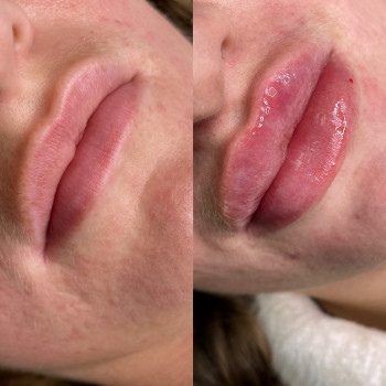 Виправляли форму, губки До вже з філлером від попереднього майстра