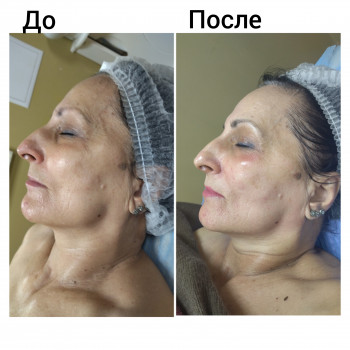 Скульптурирующий массаж лица, шеи и декольте