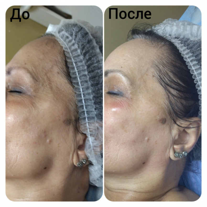 Скульптурирующий массаж лица, шеи и декольте, фото - Масажист Анна Юрьєва