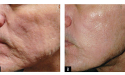 РФ ліфтінг обличчя Косметолог-эстетист Екатерина Кременчуг