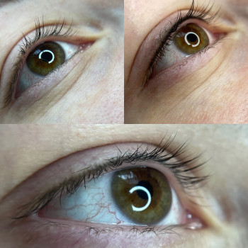 До, відразу після процедури, та перед корекцією