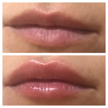 Збільшення губ