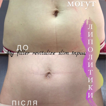 Коррекция живота