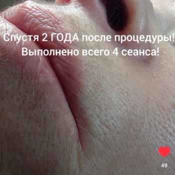 Після 2-х років, виконано 4-ре сеансу