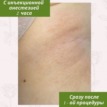 Одразу після 1-го сеансу