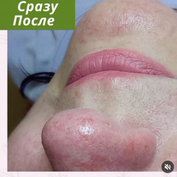 Образу після процедури видалення кератом