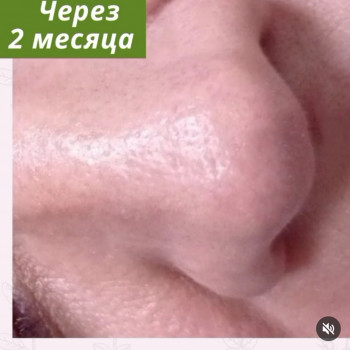 Через 2 місяця після процедури видалення кератом