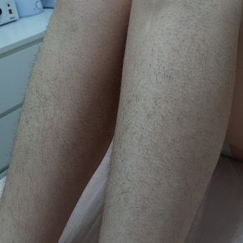 До процедури